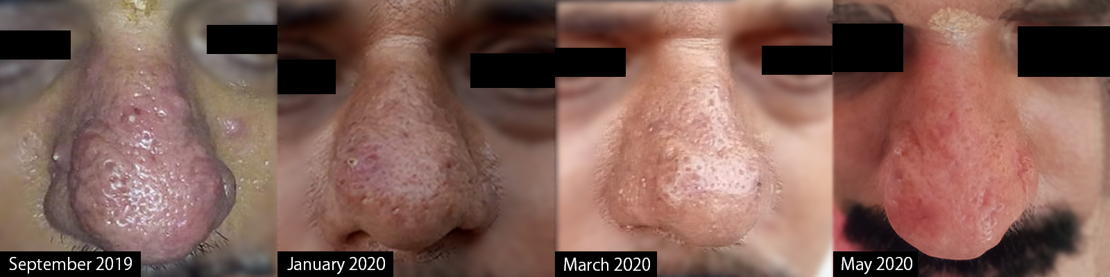 rhinophyma nose rhinophyma