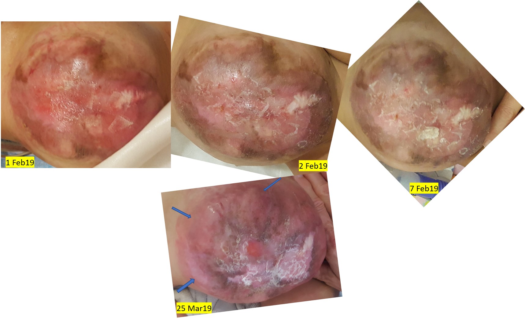 Omphalocele healing accelerated by application of wheatgrass extract to the wound