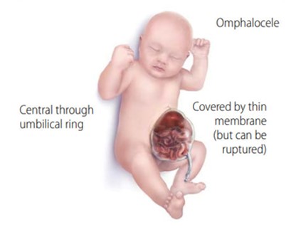 Omphalocele Fig. 1. Infantile omphalocele. Note protrusion of abdominal contents through a split in the front of the child's abdomen.