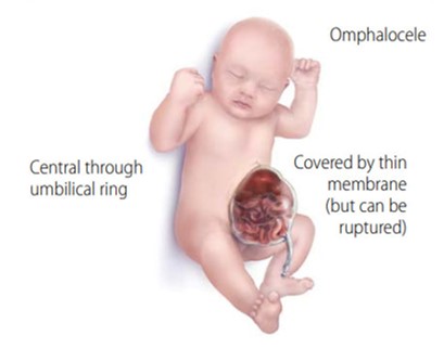 Fig. 1. Infantile omphalocele. Note protrusion of abdominal contents through a split in the front of the child's abdomen.