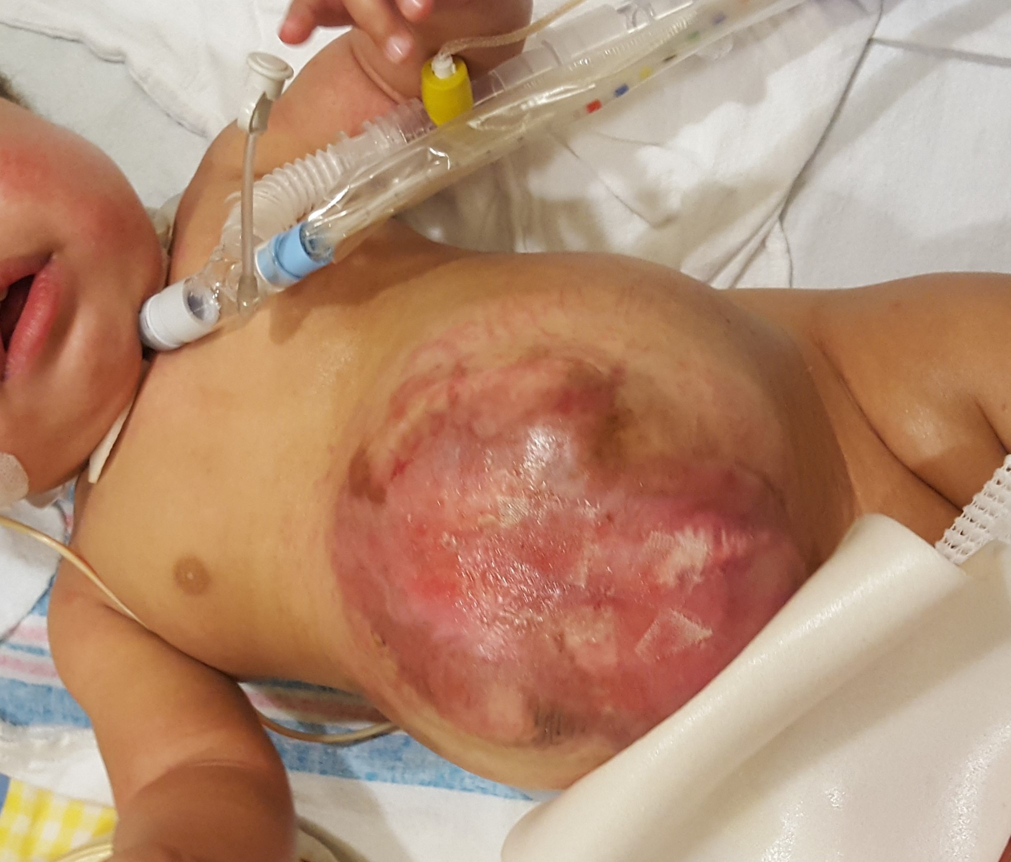 Fig. 2. Infant with omphalocele prior to application of overlying skin with wheatgrass extract.
