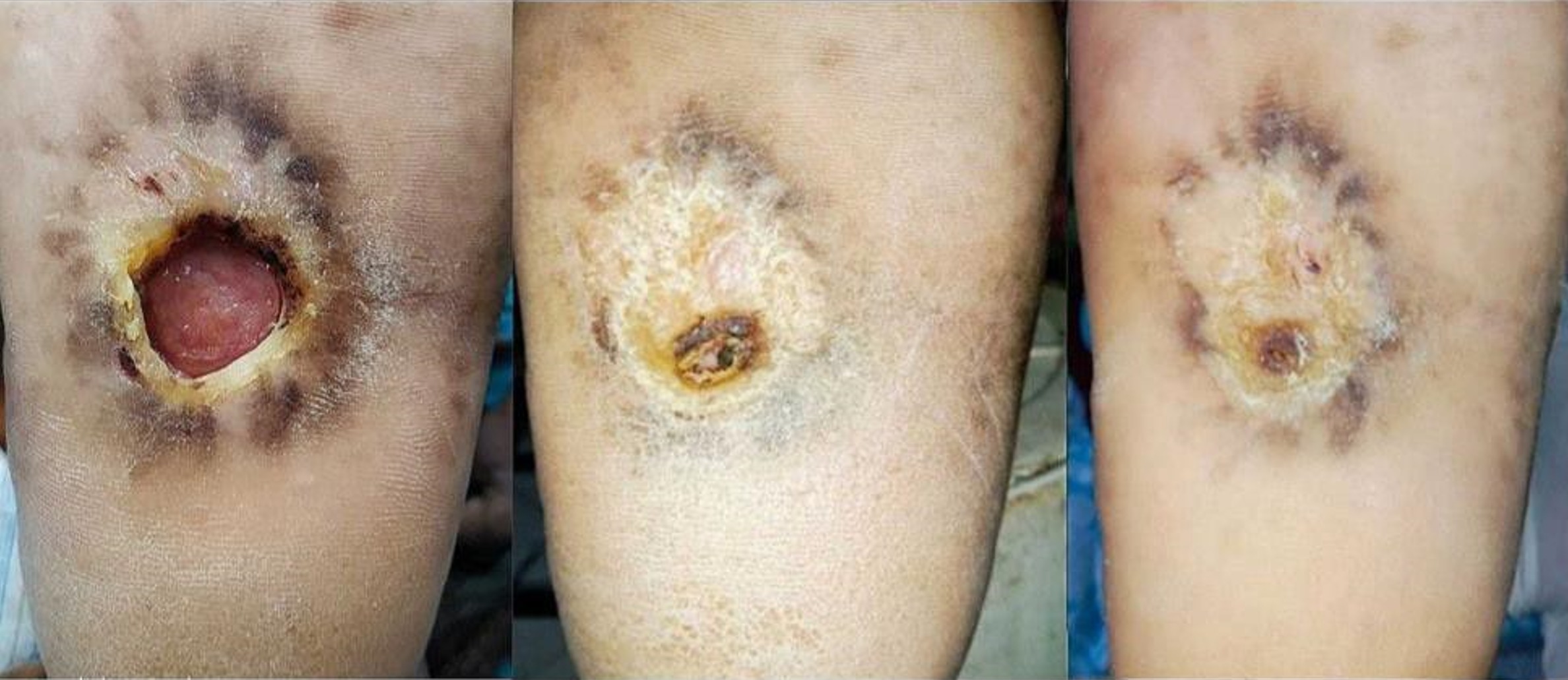 Leprosy sole of foot Leprosy