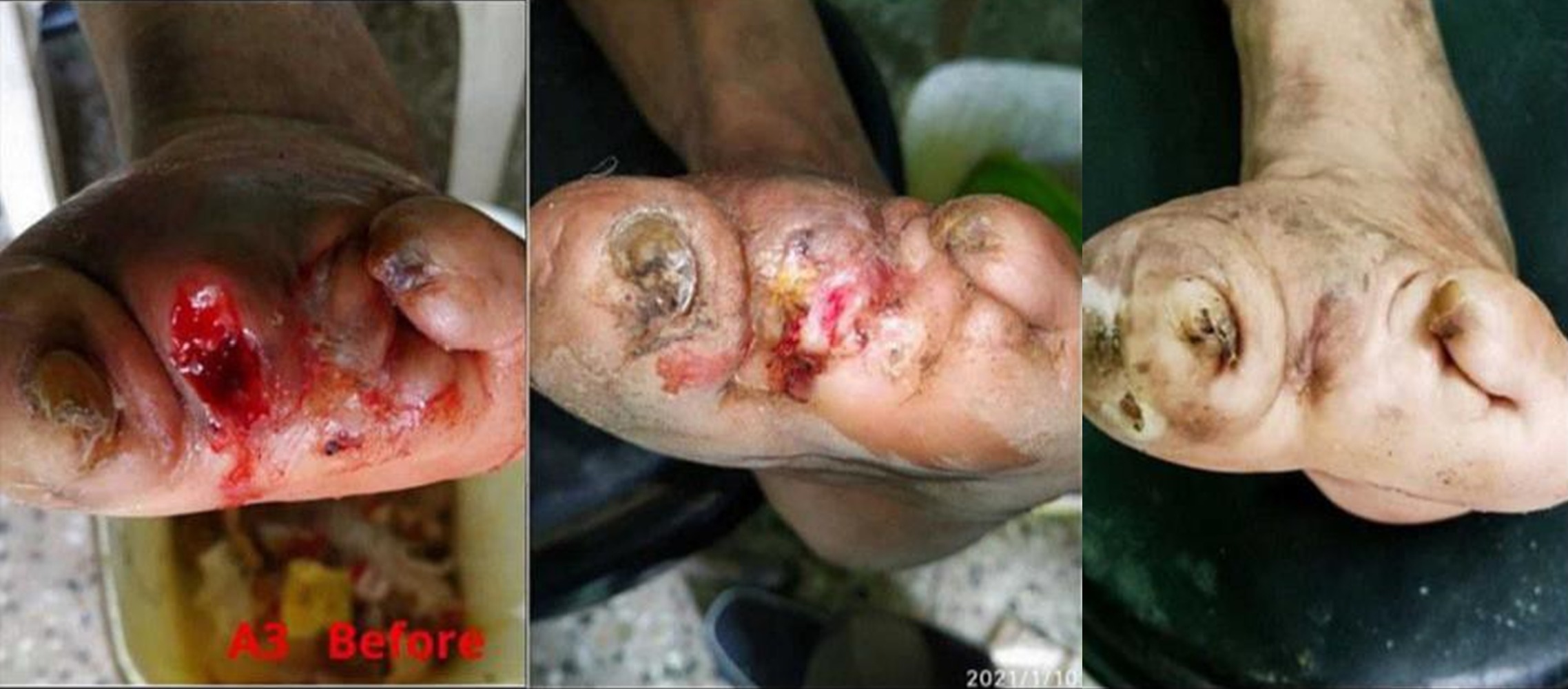 Leprosy on left foot Leprosy on foot