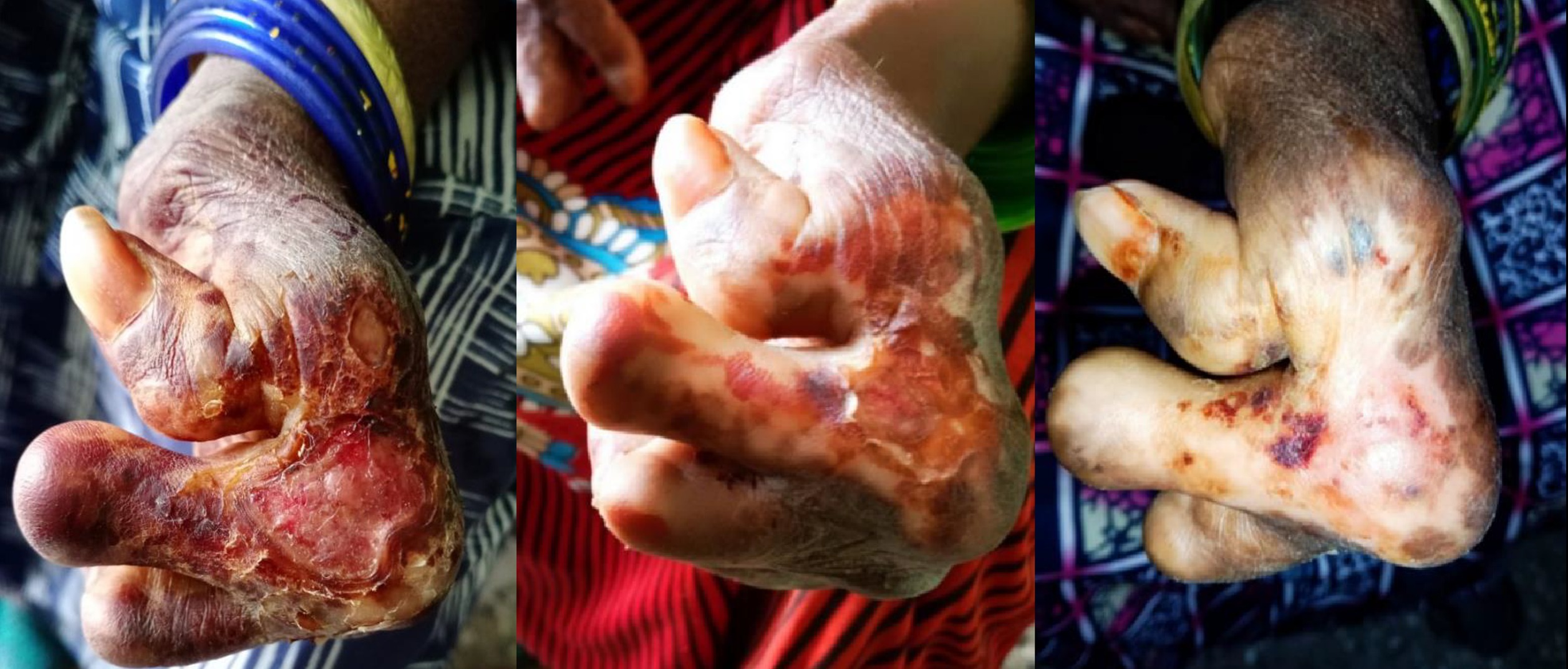 Screenshot 2021-11-22 213028 Leprosy left hand