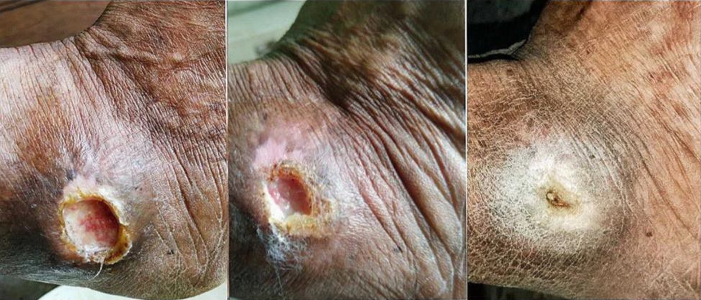 Leprosy Ulcer on Right Ankle Leprosy on ankle