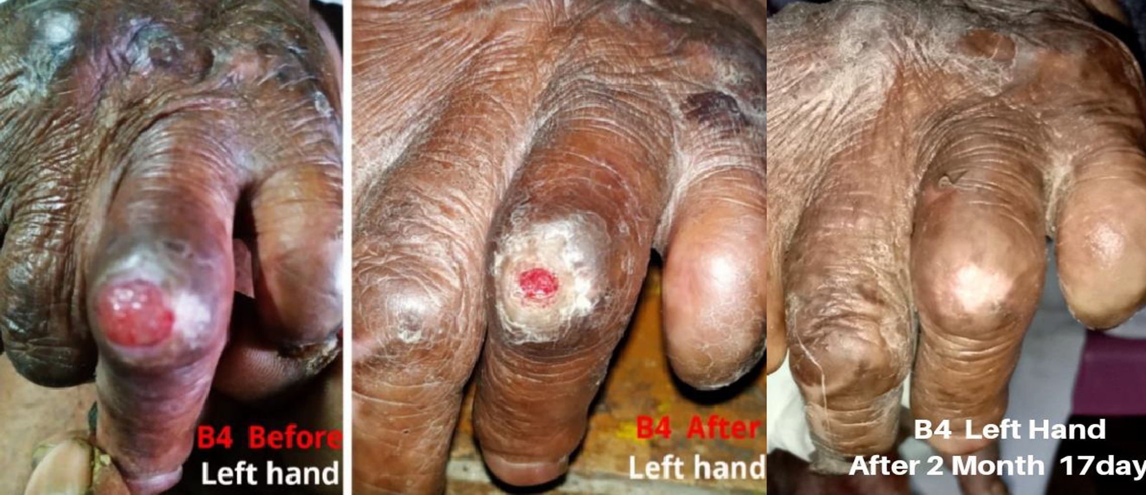 Leprosy Ulcer on Left Hand Leprosy left hand