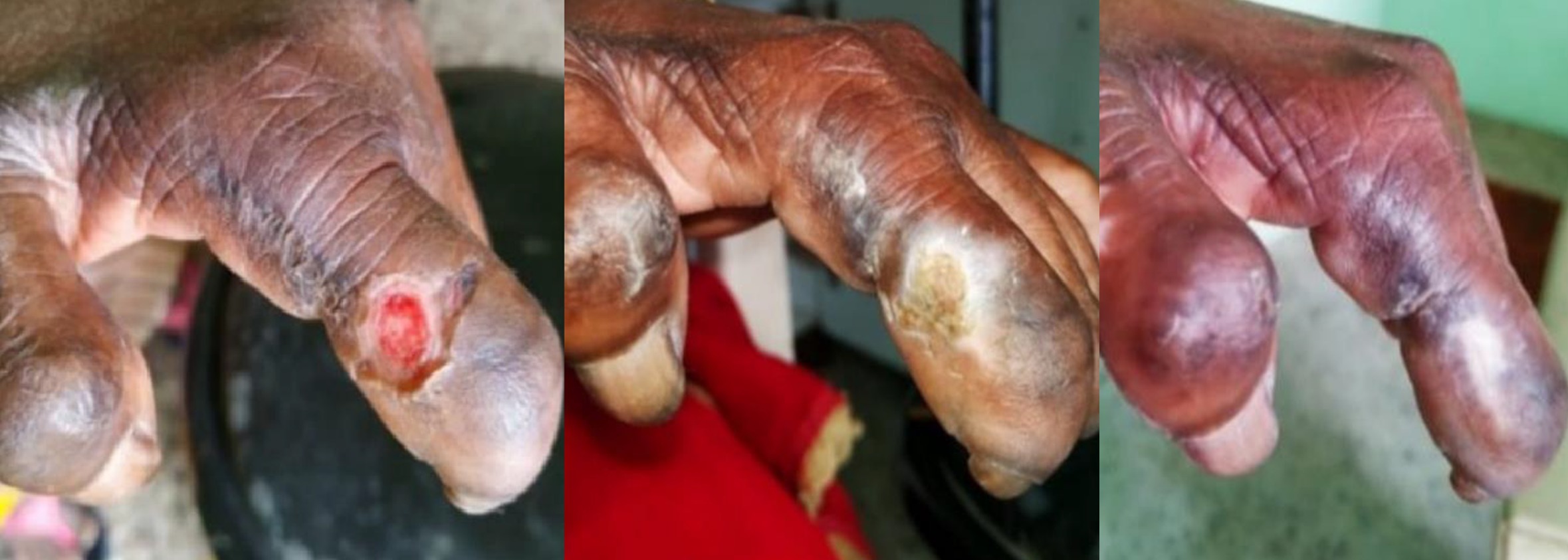 Leprosy Ulcer on Left Hand Leprosy ulcer on hand