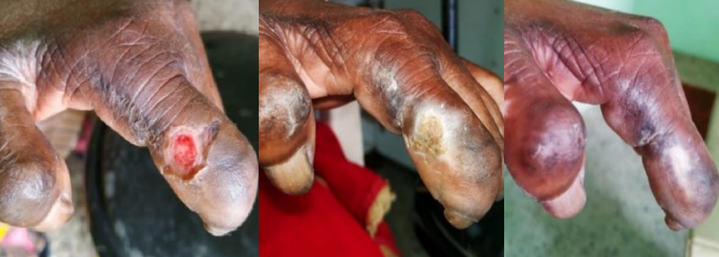 Leprosy ulcer on hand