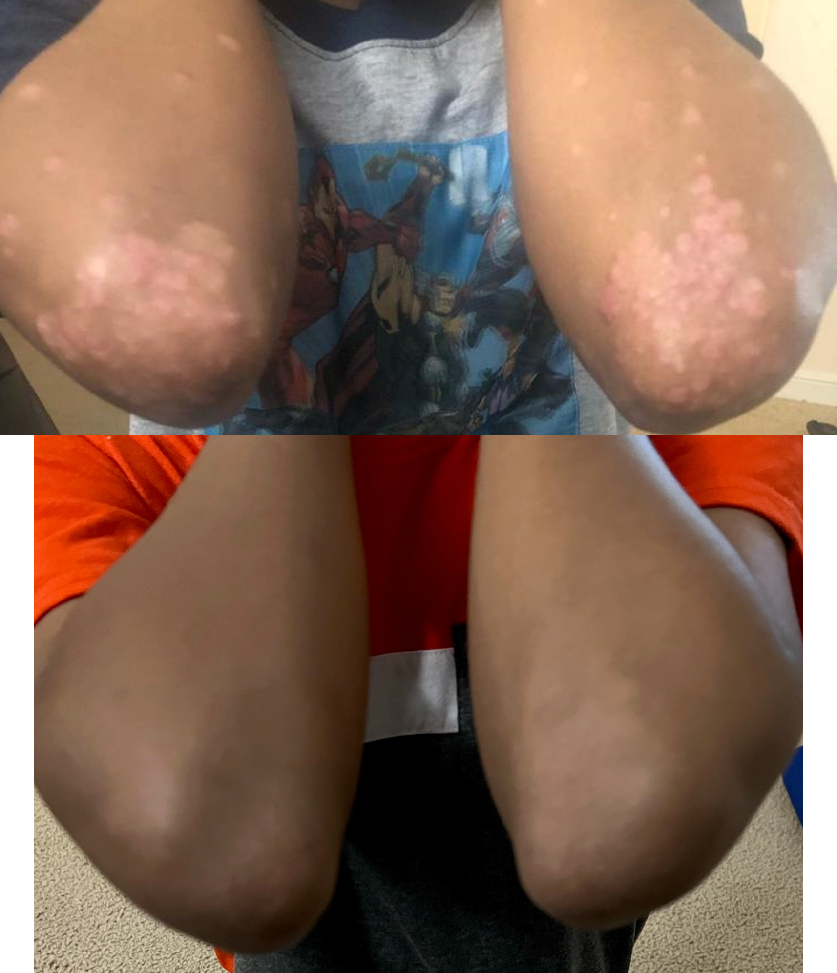 VITILIGO ELBOWS Before and after photographs of the elbows of a vitiligo patient