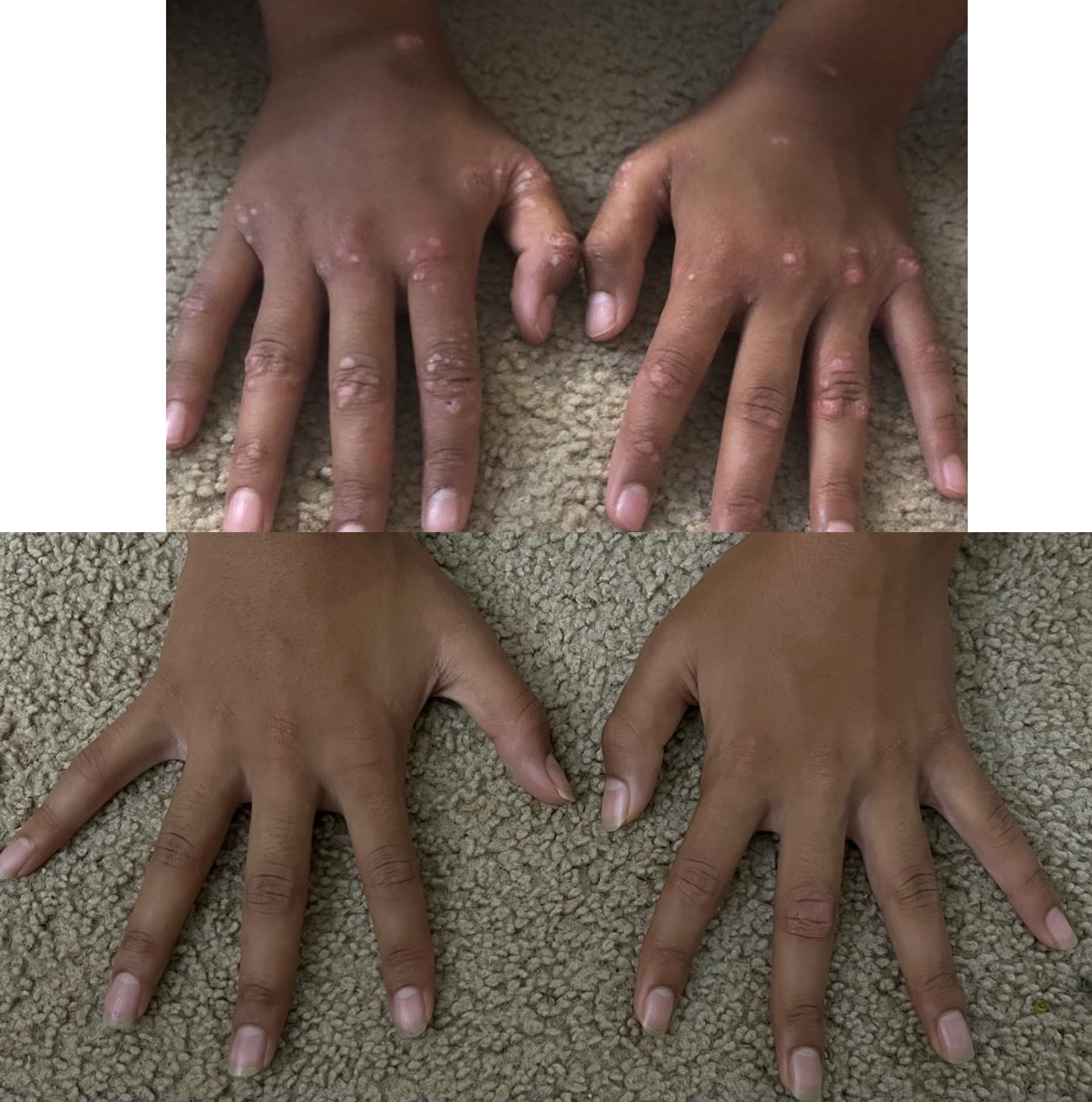 Photograph of the hands of a vitiligo patient