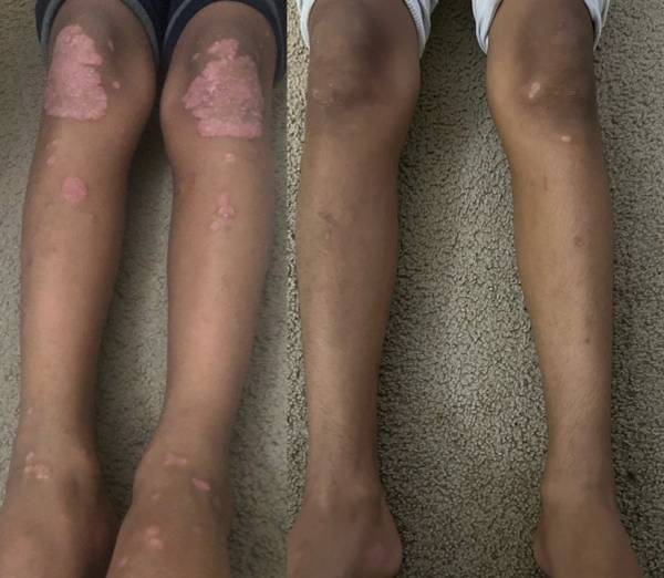 Vitiligo legs Before and after photograph of the legs of a vitiligo patient