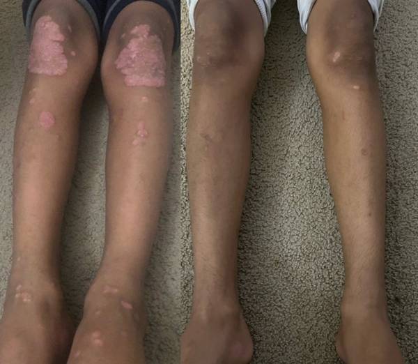 Before and after photograph of the legs of a vitiligo patient