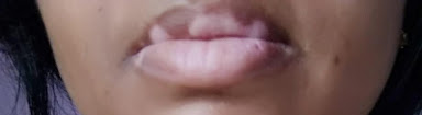 Photograph of the lips of a vitiligo patient